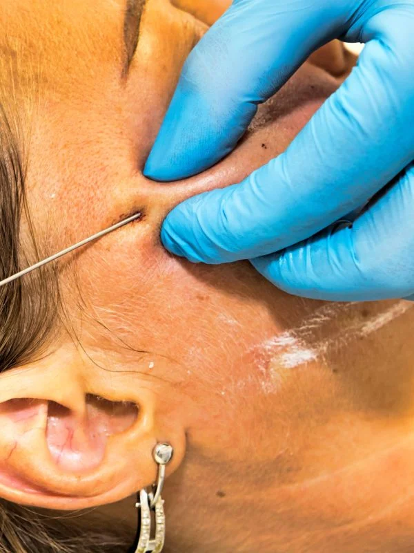Skin Tightening treatment at Rejuven8 Medical in Sugar Land, TX